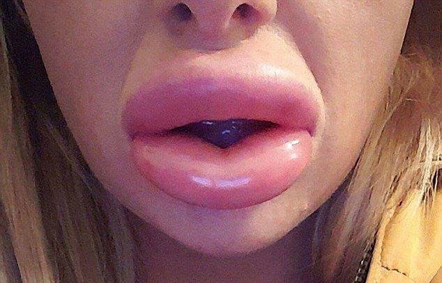 После косметической процедуры губы превратились в сосиски