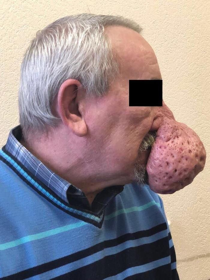 Петербургские медики отрезали мужчине полукилограммовую часть носа