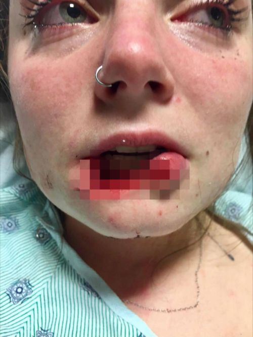 Кровавое расставание: парень попытался откусить девушке губу