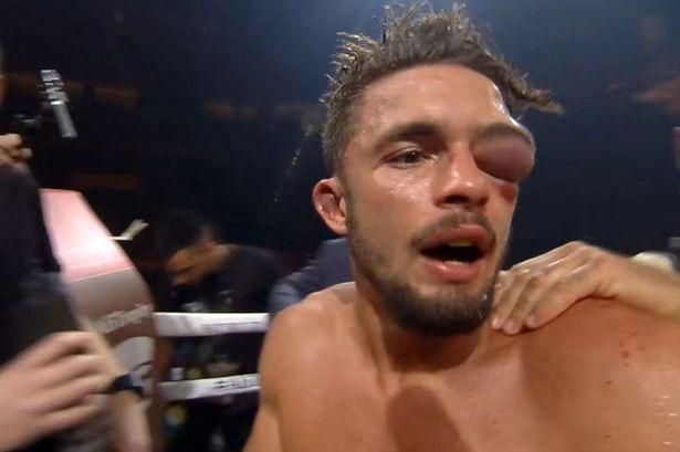 Пузырь вместо глаза: жуткая травма шведского боксера, полученная в бою против белоруса Баранчика
