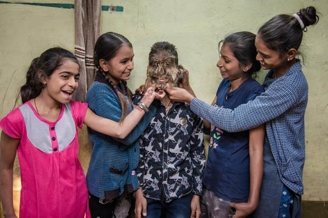 13-летний Лалит Патидар - "мальчик-оборотень" из Индии