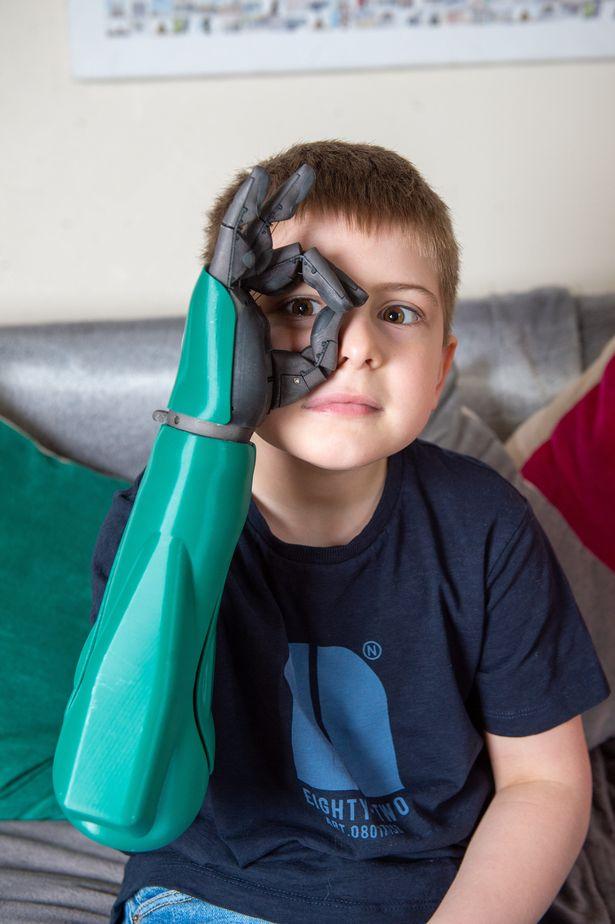 8-летний мальчик стал самым юным обладателем бионической руки