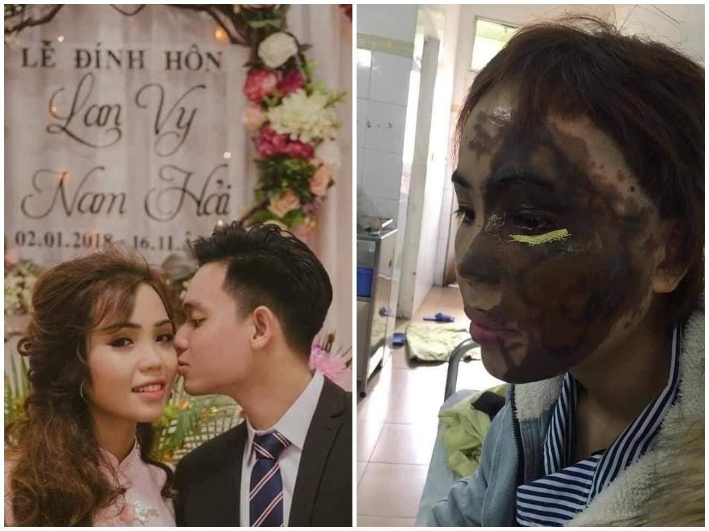 Вьетнамец накануне свадьбы облил невесту кислотой
