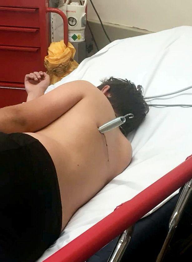 Школьник попал на операционный стол после того, как в него выстрелил батут