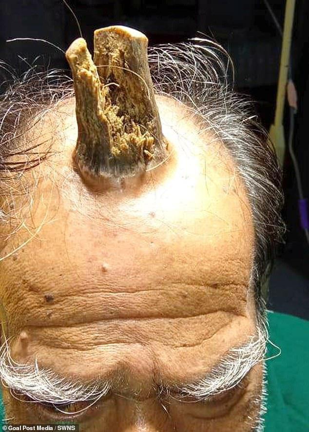 В Индии врачи удалили мужчине с головы 10-сантиметровый рог