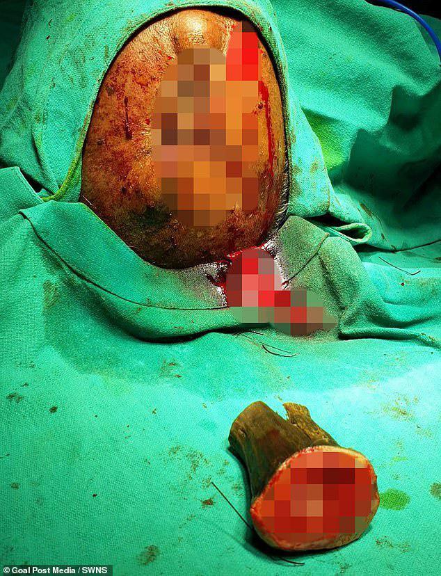 В Индии врачи удалили мужчине с головы 10-сантиметровый рог