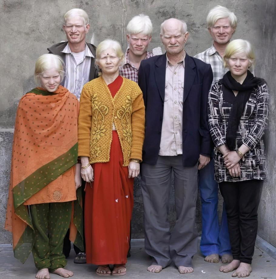 Как выглядят альбиносы в Индии Всячина