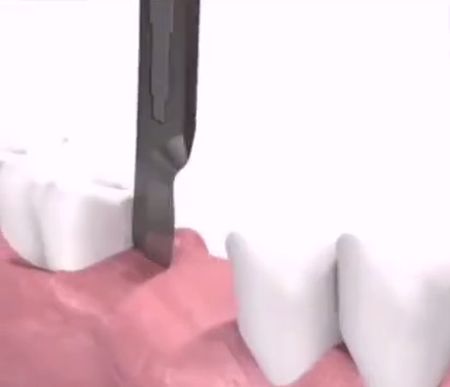 Как устанавливают зубной имплант