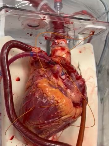 Сердце перед трансплантацией⁠⁠