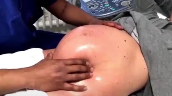 Немецкий акушер переворачивает детей в животе матери, чтобы избежать кесарева сечения