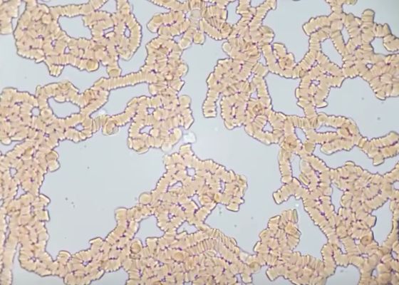 Водка, коньяк - как влияют на состояние крови