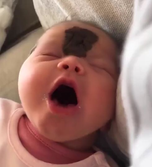 Успешное удаление родимого пятна у маленькой принцессы