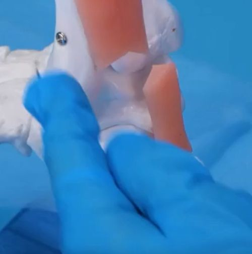 Как лечат порванный ахиллес