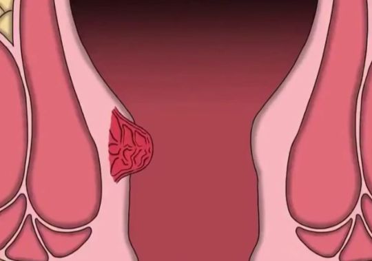 Почему нельзя откладывать визит к проктологу: поучительный мультик из Кореи о лечении геморроя